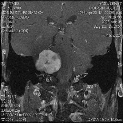 MRI of 4.6cm brain tumor successfully removed by top neurosurgeons, Dr. Derald Brackmann and Dr. Schwartz.  Contact me if faced with similar outlook - there is hope!