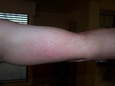 CPES Rash