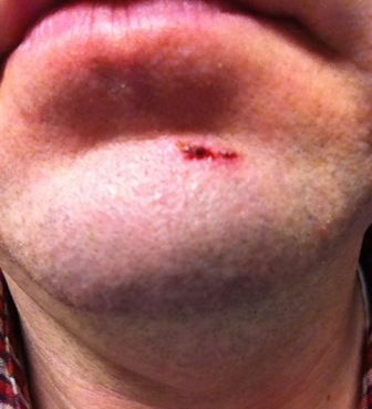 Busted Chin