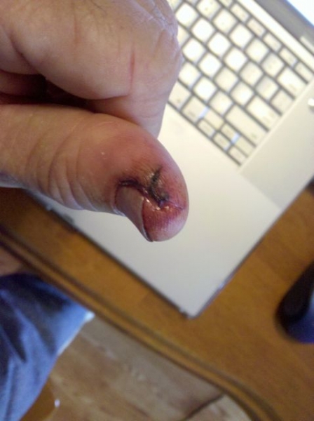 Hole in the thumb